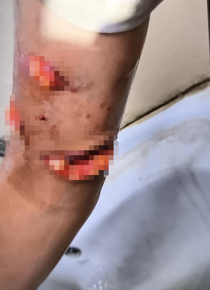 Suruç’ta başıboş köpekler 8 yaşındaki çocuğa saldırdı