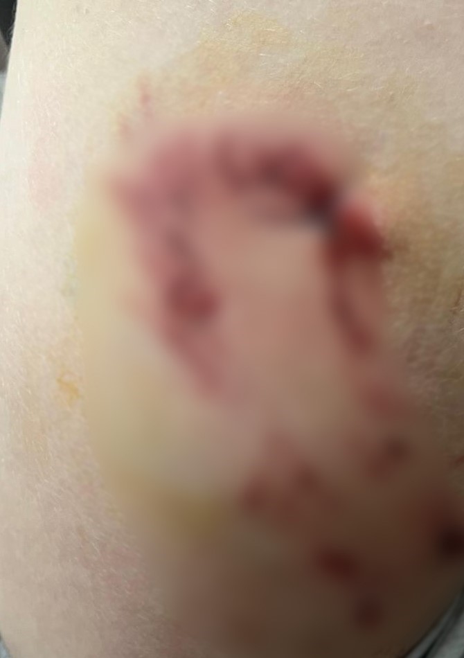 Bolu’da Belçika kurdu çocuğu kalçasından ısırdı, sahibinin sözleri pes dedirtti