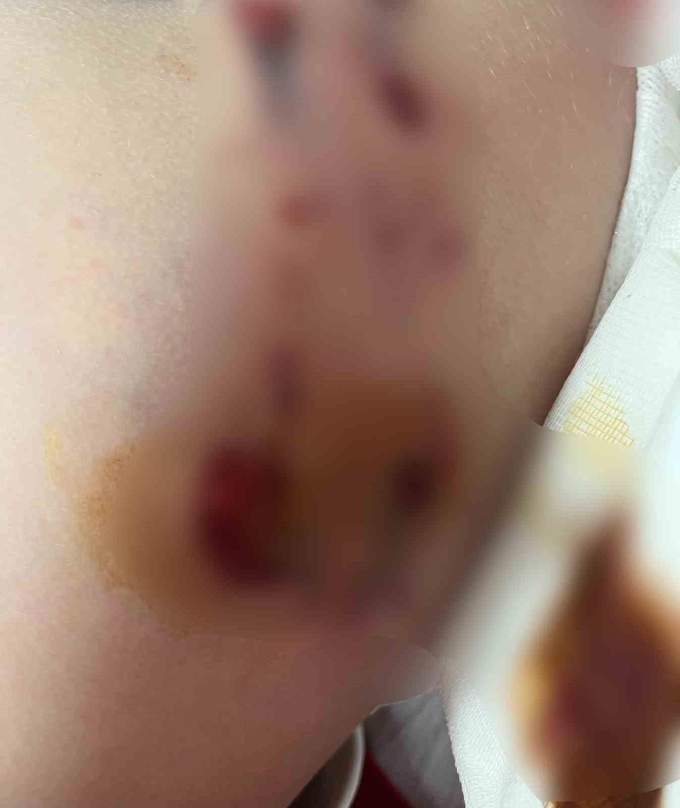 Bolu’da Belçika kurdu çocuğu kalçasından ısırdı, sahibinin sözleri pes dedirtti