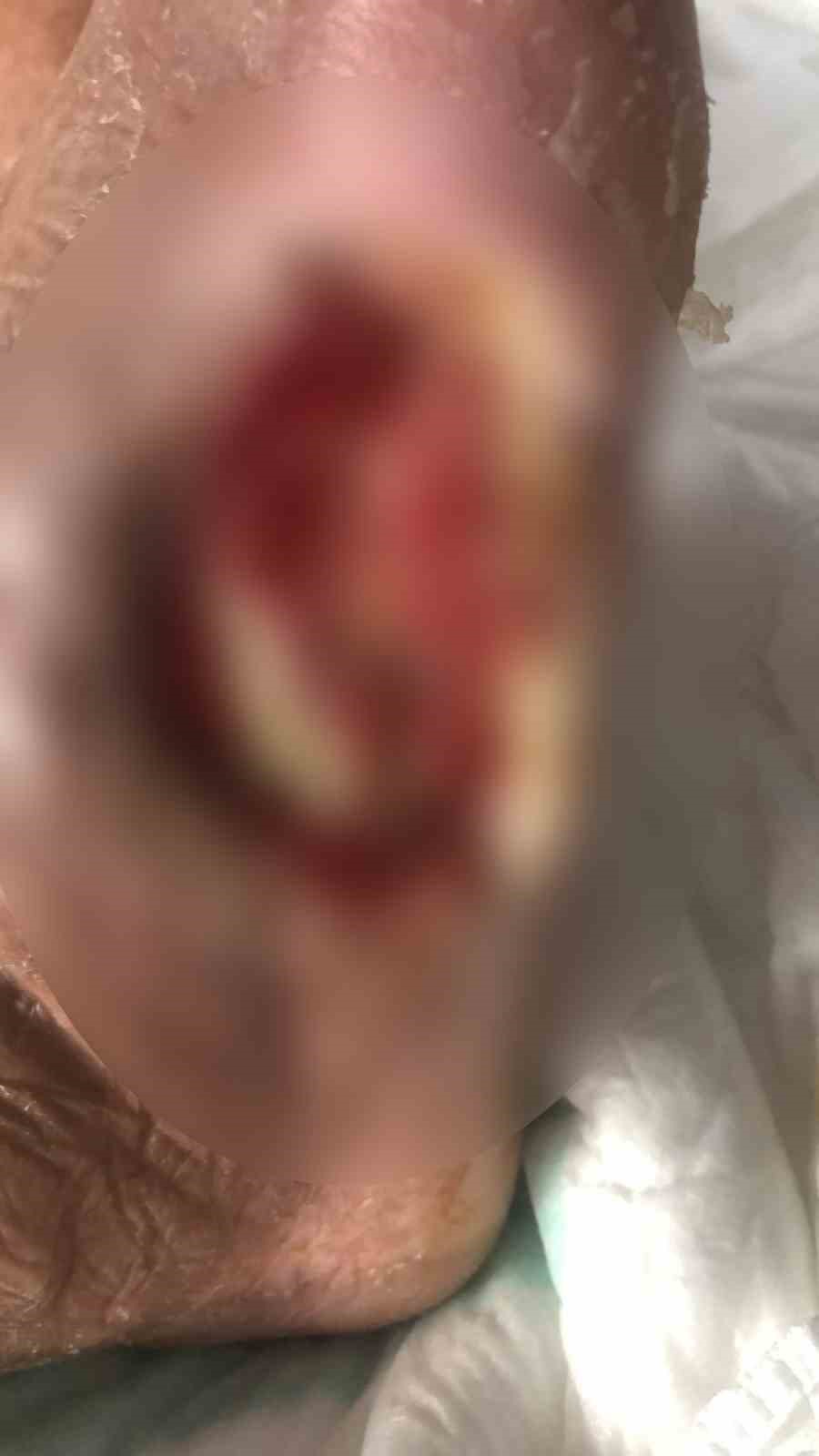 Ayağı kesilmek üzere olan emekli madenci, çözünebilir deri ile sağlığına kavuştu