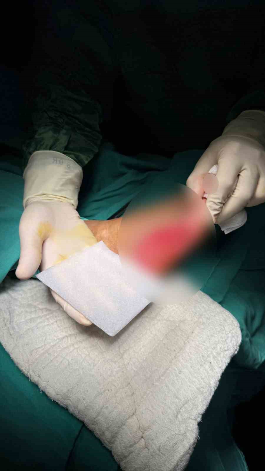 Ayağı kesilmek üzere olan emekli madenci, çözünebilir deri ile sağlığına kavuştu