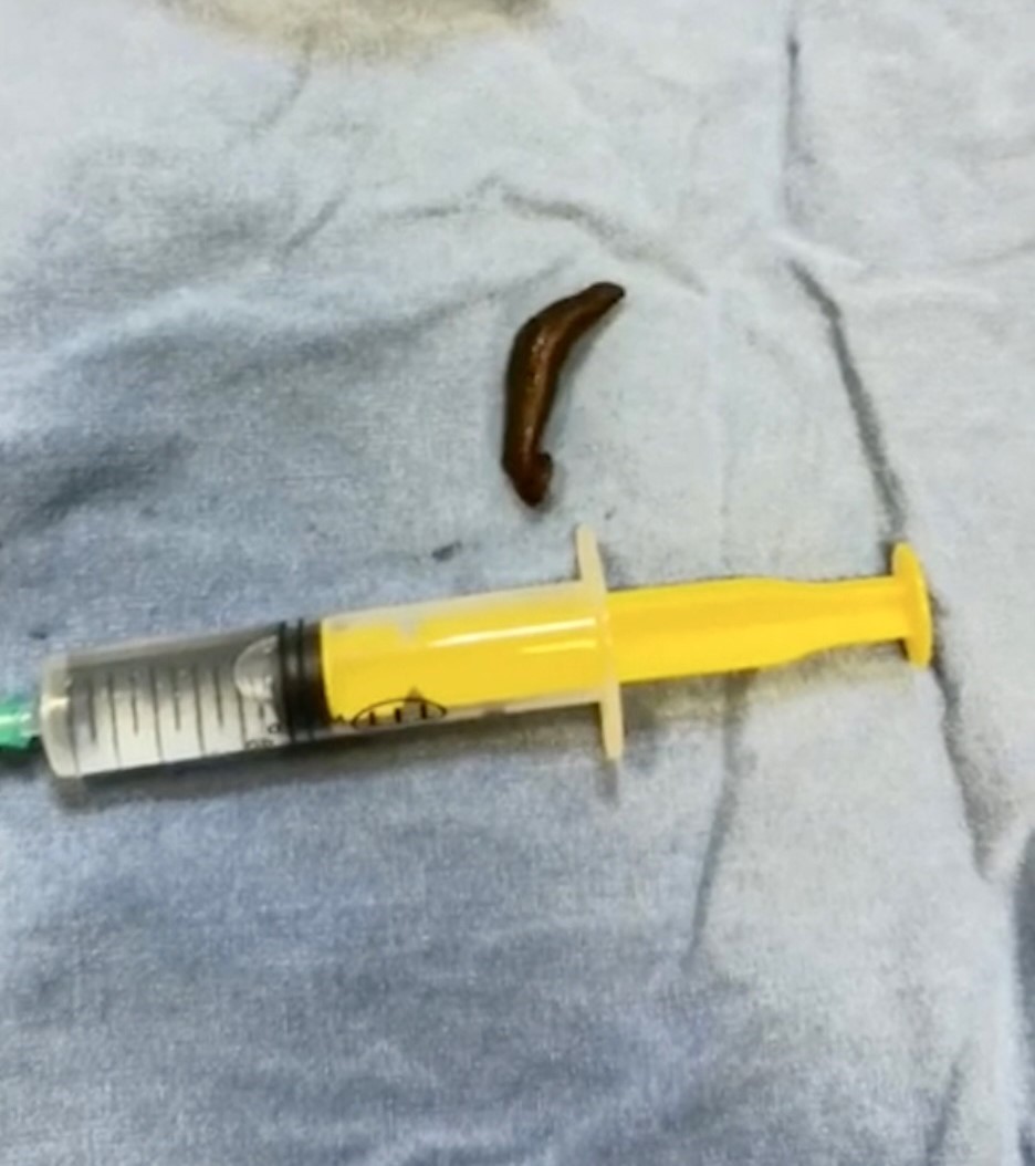 Vatandaşın boğazından çıkan canlı sülük doktorları bile şaşırttı: "İlk defa gördüm"