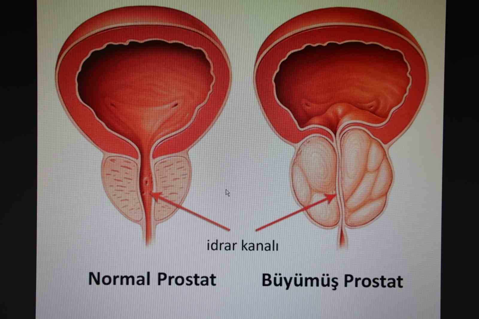 Üroloji Uzmanı Op. Dr. Yüzgeç: "Erkeklerin 50 yaşından sonra yılda bir defa prostat muayenesini yaptırmaları gerekiyor"