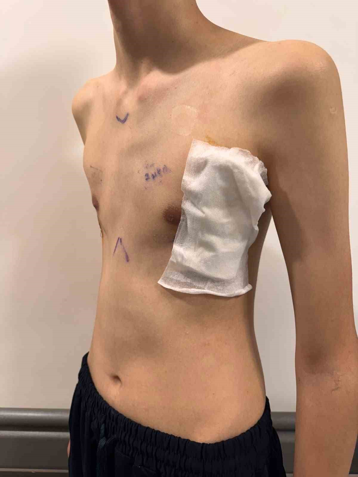 Samsun Şehir Hastanesinde ilk: 17 yaşındaki çocuğun ’kunduracı göğsü’ kapalı ameliyatla düzeltildi